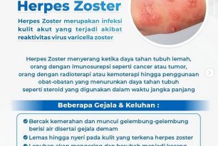 Herpes Zoster Herpes Zoster