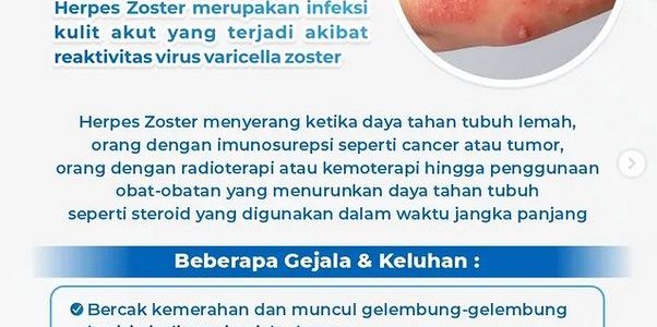 Herpes Zoster Herpes Zoster